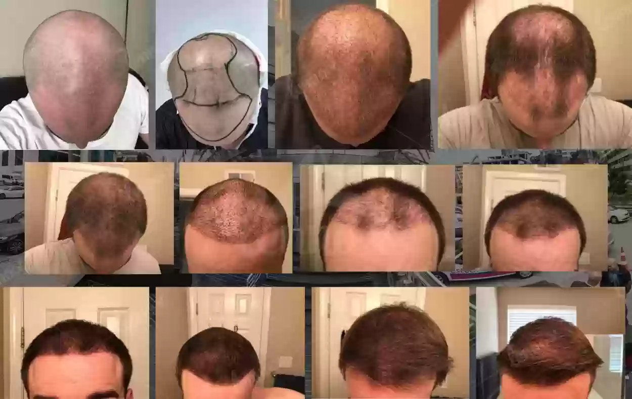 زراعة الشعر لا تسبب السرطان